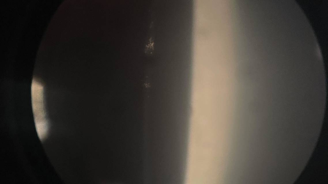 cataract