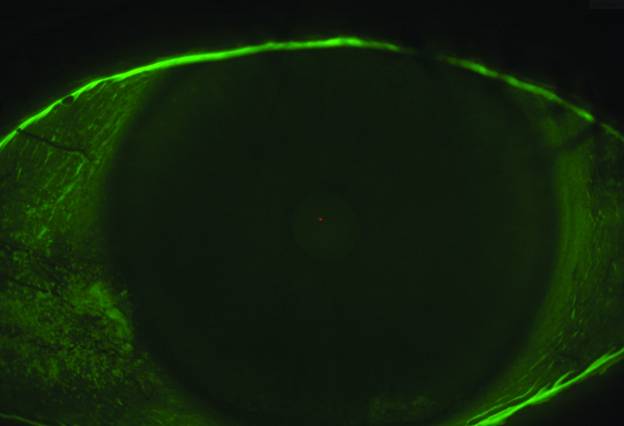 dry eye imaging
