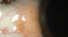 Performing an Optical Biopsy With HR OCT