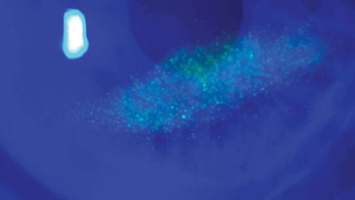 neurotrophic keratitis