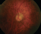 Modern Management Of Vitreous Opacities Acquiring History And Performing A Thorough Clinical Examination