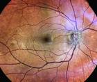 Optic Neuritis
