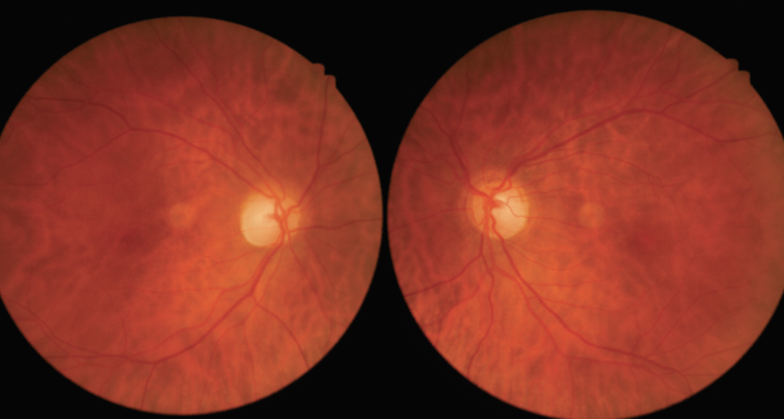 Fundus photography