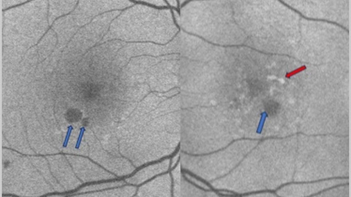 GA Case Compendium Rapid Loss of Vision Associated With Geographic Atrophy