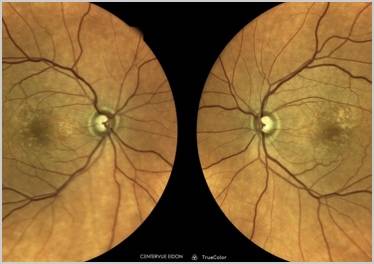 Clinical Case Compendium Setting Expectations and Patient Education in Geographic Atrophy Management