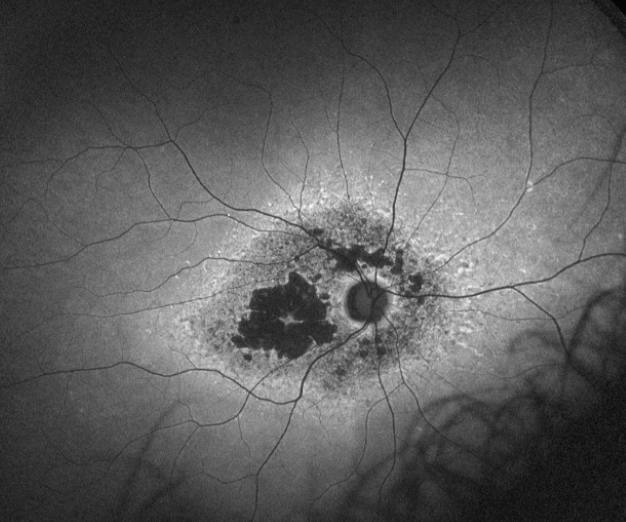 Stargardt disease