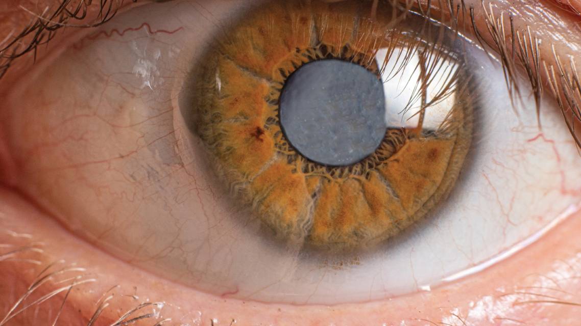 Management of NK in the Surgical Patient