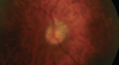 Modern Management Of Vitreous Opacities Acquiring History And Performing A Thorough Clinical Examination