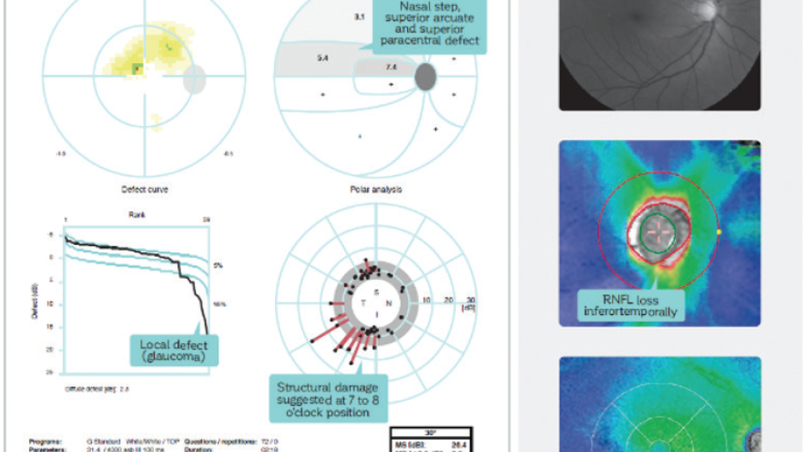 Structure and Function in Early Glaucoma Diagnosis