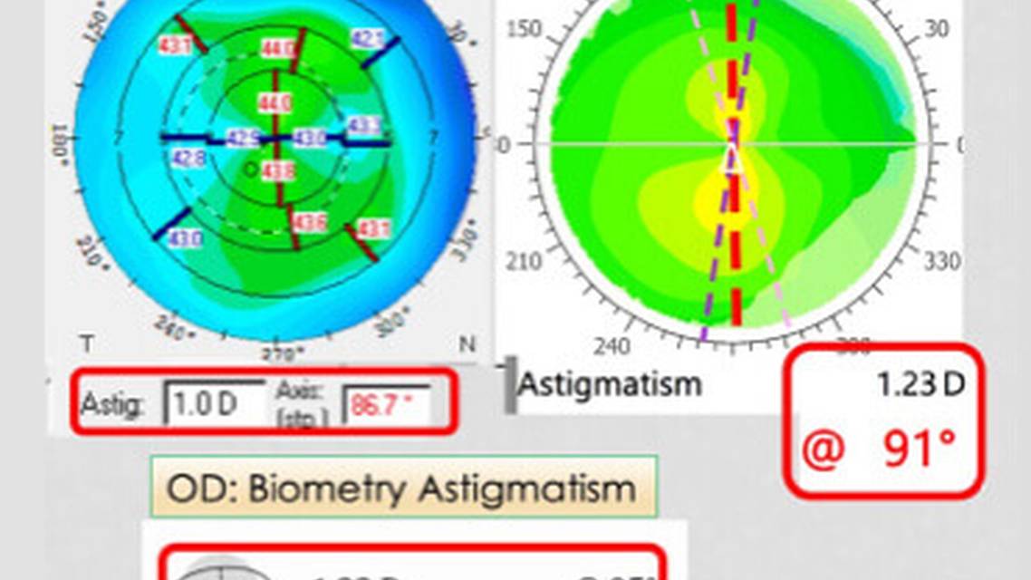 Collaborative Case 010 Managing the Unhappy Presbyopic IOL Patient