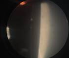 cataract