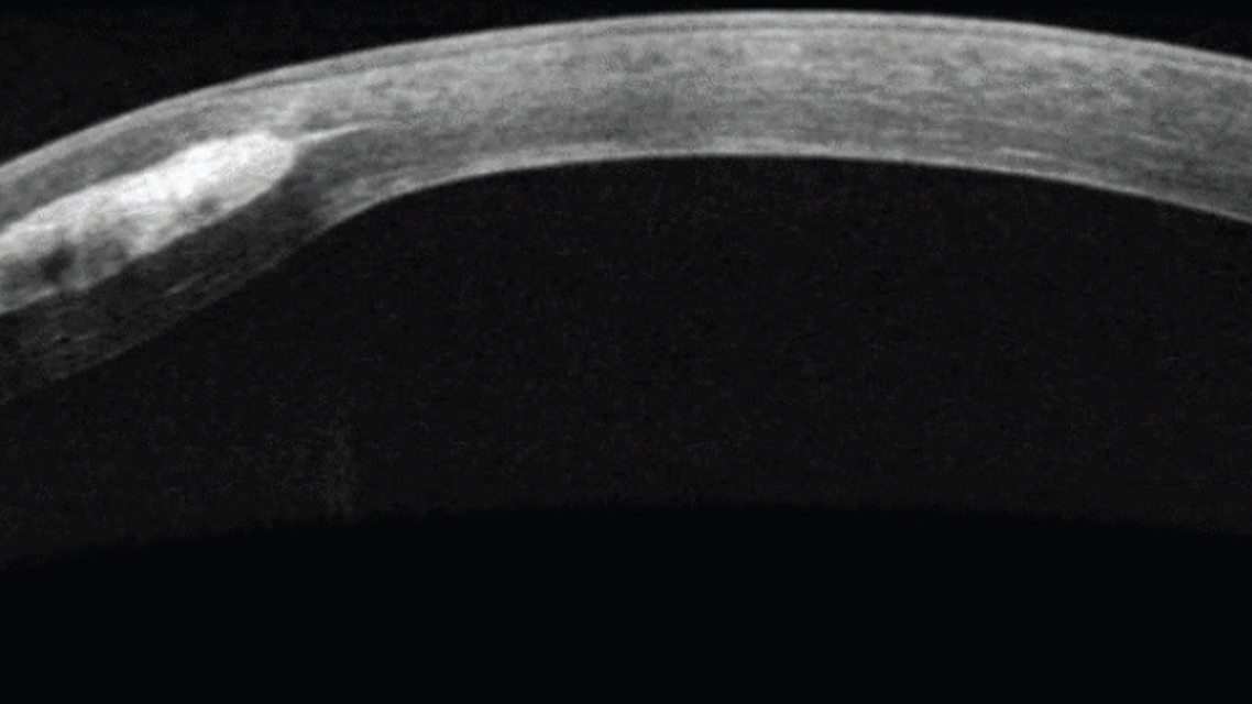 A New Multifaceted Approach to the Holistic Management of Keratoconus