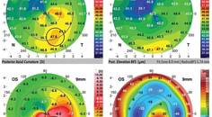 The Art and Science of Managing Post LASIK Keratectasia