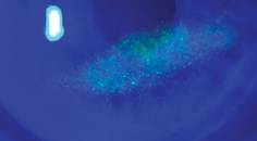 neurotrophic keratitis