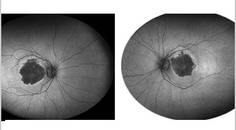 GA Case Compendium Image Findings Suggesting Risk of Geographic Atrophy Progression