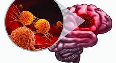 Glioblastoma Multiforme