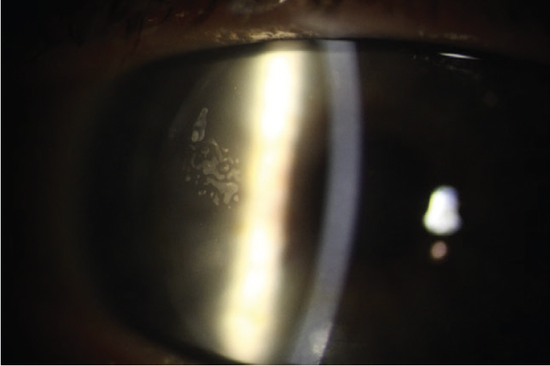 The OD’s Role in Postoperative Refractive Surgery Care