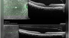 GA Case Compendium Challenges in Patient Education and Treatment Decision Making for Geographic Atrophy