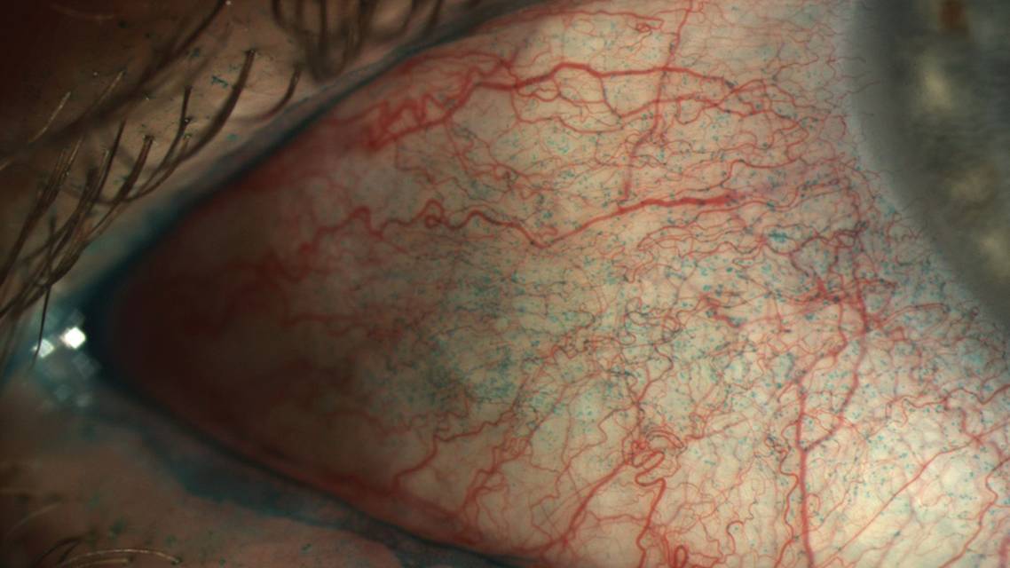 Whats Your Dry Eye Acumen