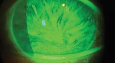 Limbal Stem Cell Deficiency