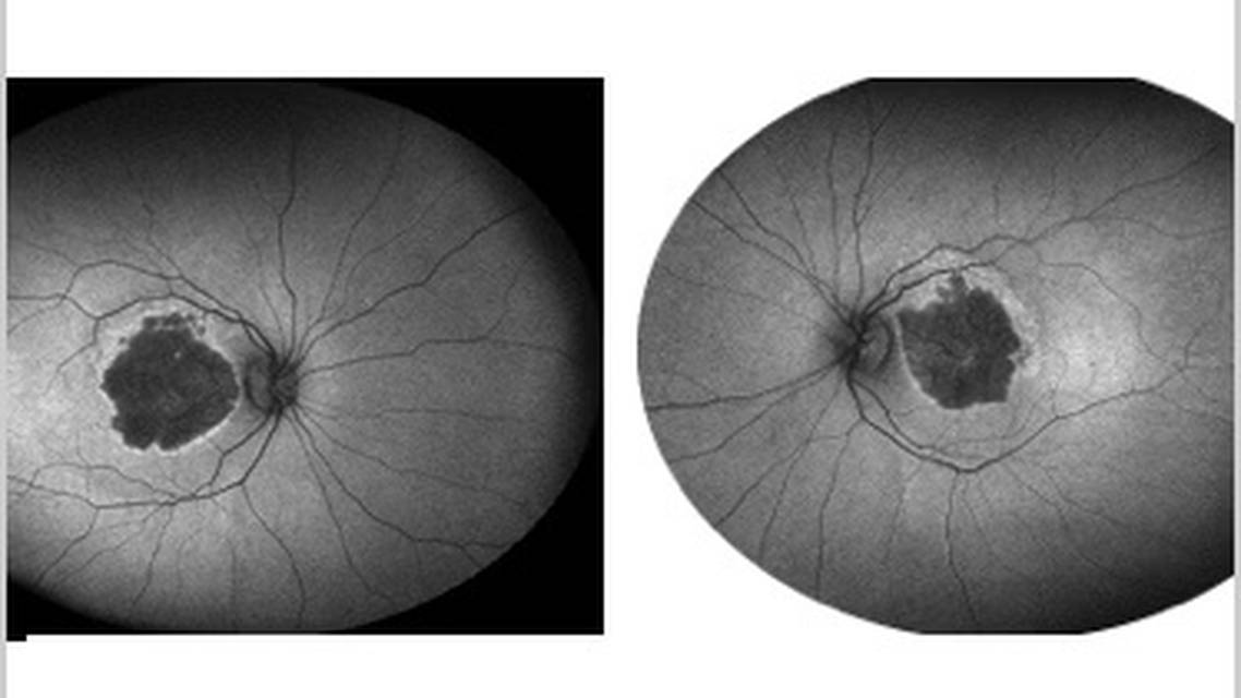 GA Case Compendium Image Findings Suggesting Risk of Geographic Atrophy Progression