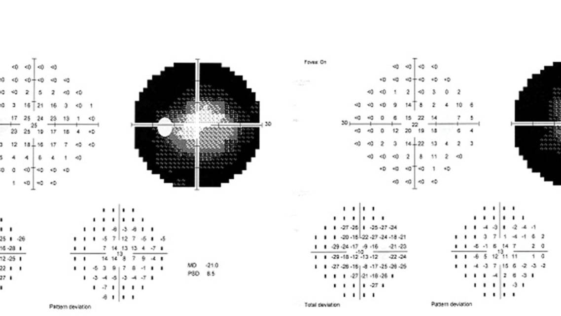 Visual fields amblyopia