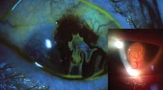 Managing Ocular Perforations
