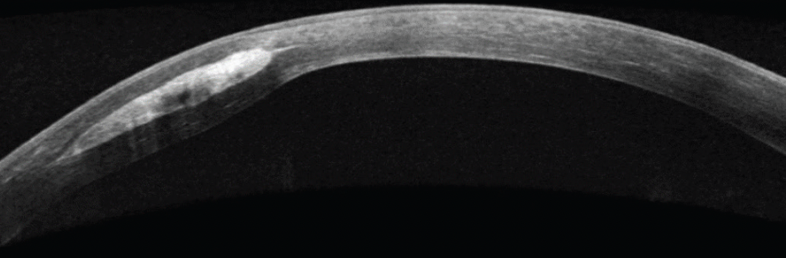 A New Multifaceted Approach to the Holistic Management of Keratoconus