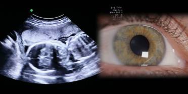 Ultrasound Gave Us Our First Baby Pictures. Can It Also Help the Blind See? image