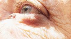 Osteoporosis and the Eye