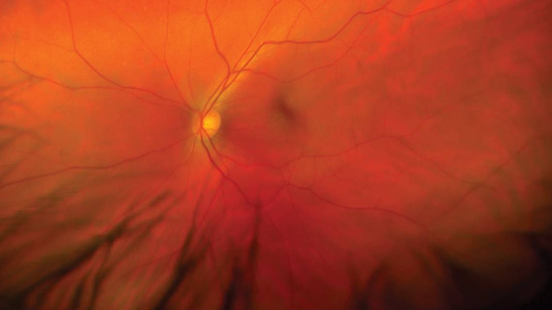 Retina in Review