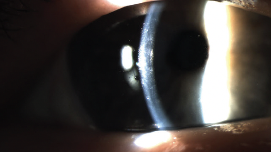 Preoperative Considerations in Cataract Surgery