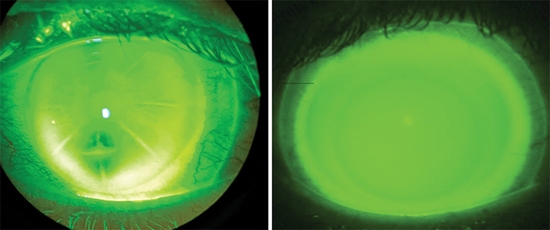 Rgp Staining Pattern Specialty Lenses and Corneal Disease