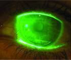 dry eye image