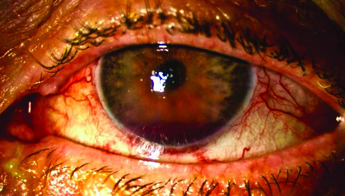 UGH syndrome in an eye anterior segment image