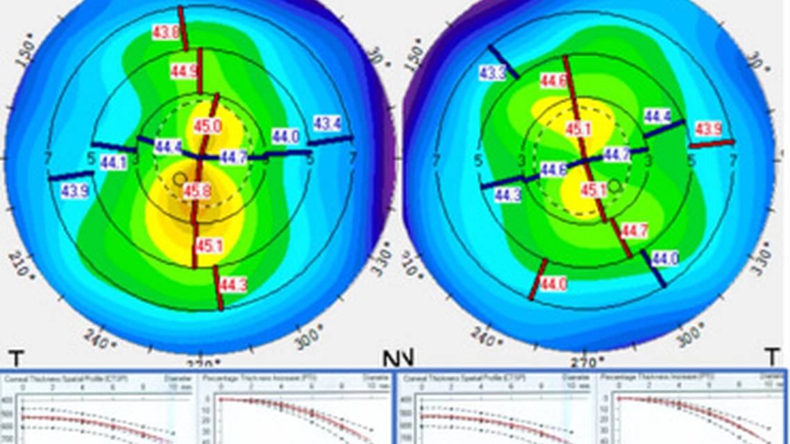 Collaborative Case 011 Treating Irregular Astigmatism After Laser Vision Correction