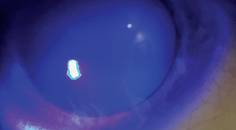Recognizing and Managing Limbal Stem Cell Deficiency