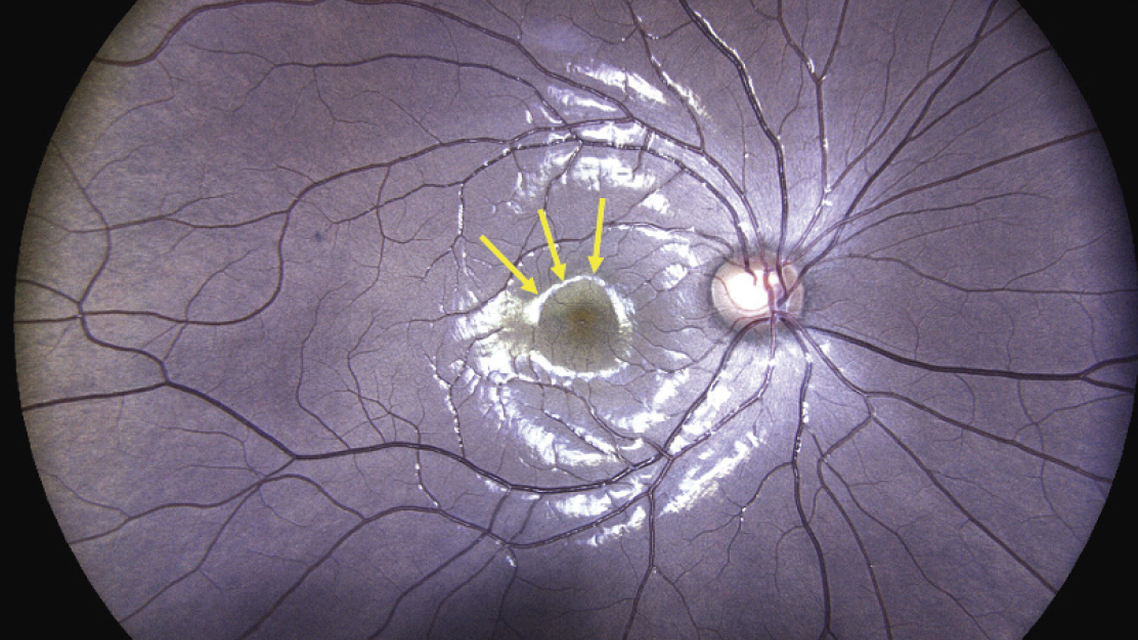 Commotio Retinae in a Teenager