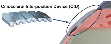 Ciliatech Releases New Design of Glaucoma Surgical Device CID image