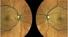 Clinical Case Compendium Setting Expectations and Patient Education in Geographic Atrophy Management