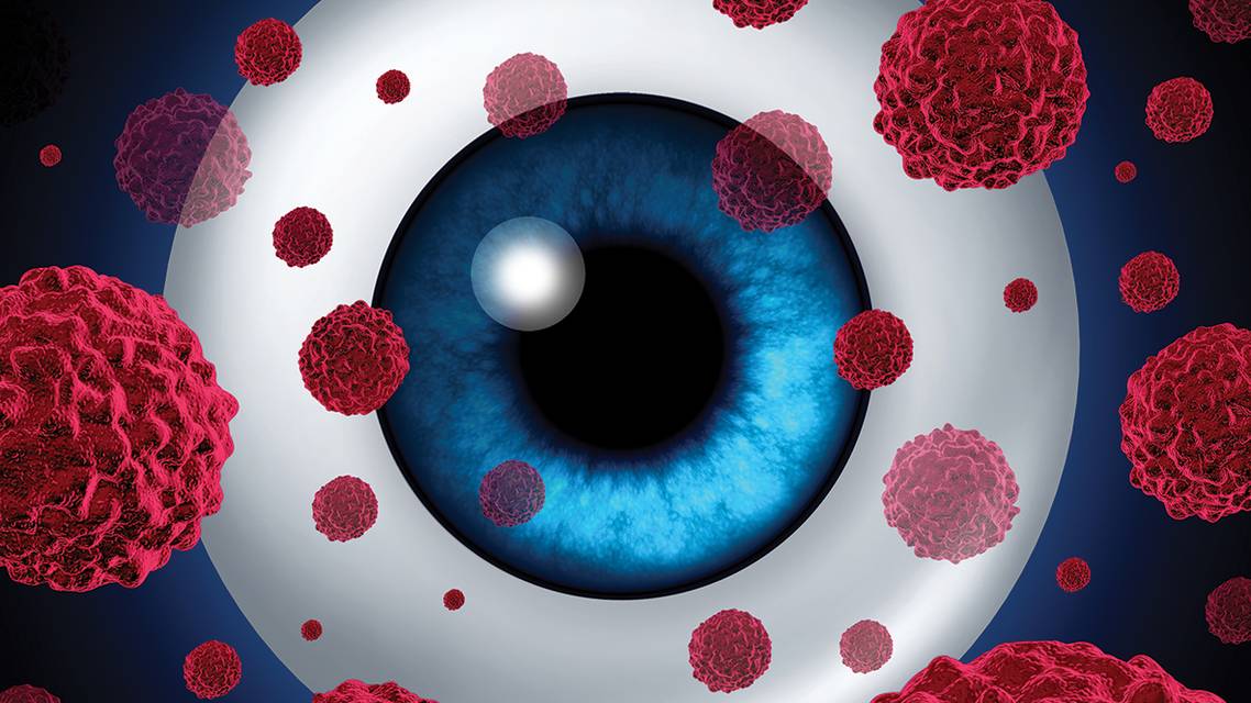 Cancer and the Posterior Pole