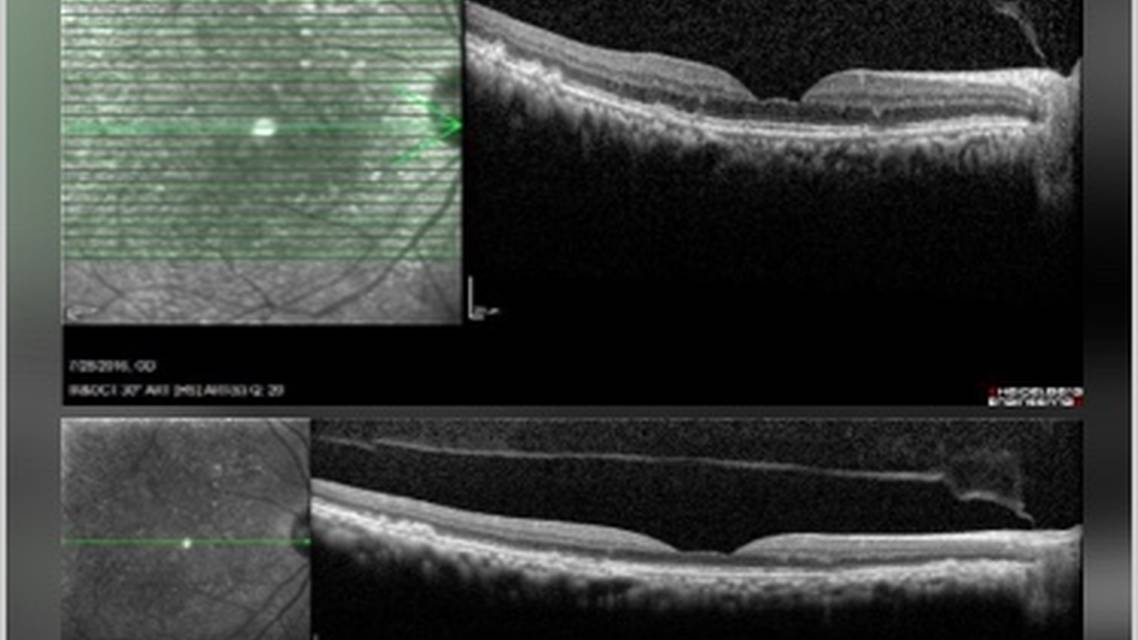 GA Case Compendium Challenges in Patient Education and Treatment Decision Making for Geographic Atrophy