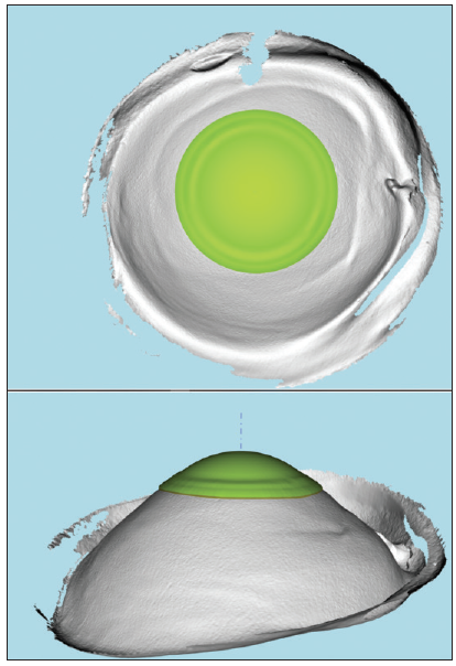 Infant Rgp Specialty Contact Lens Fitting in Children