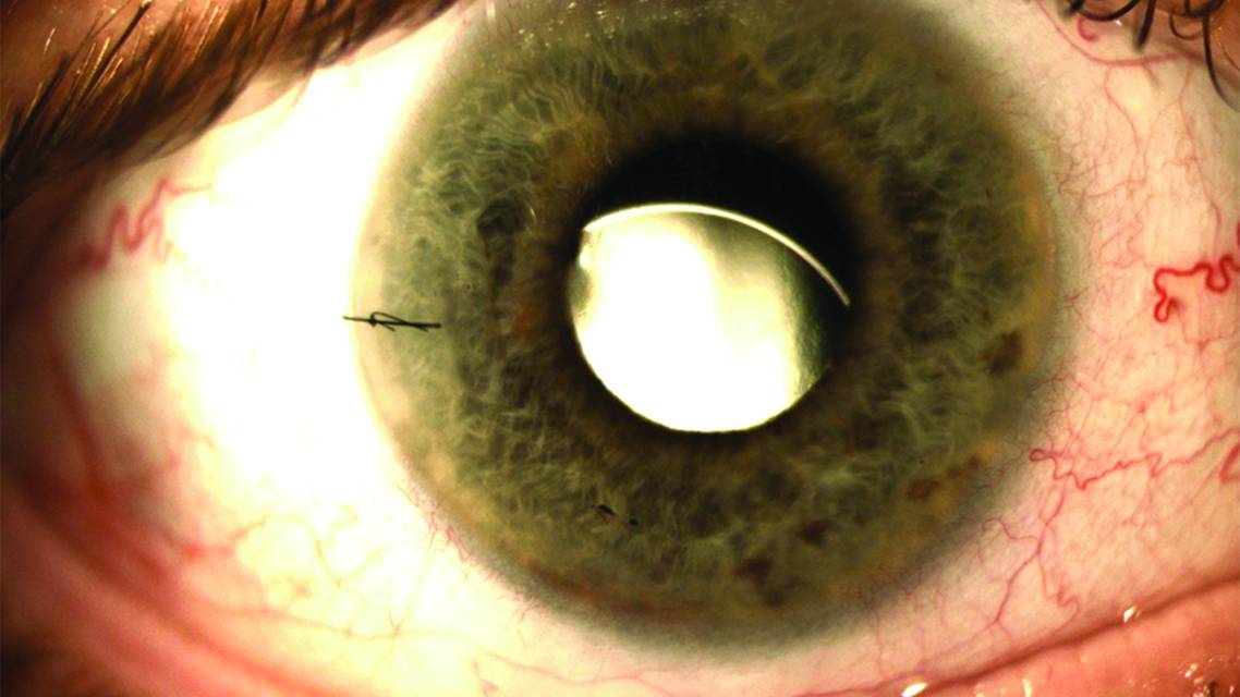 Techniques for Repairing Dislocated IOL