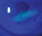 neurotrophic keratitis