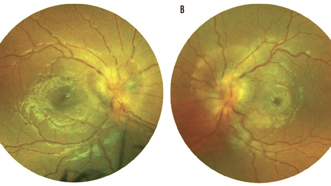 Neuroretinitis From Cat Scratch Disease