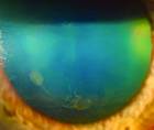 The Expanding Differential of Corneal Verticillata