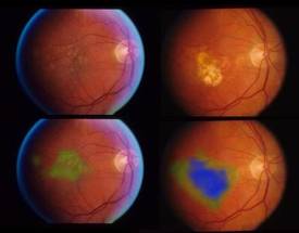 AI-based Systems Can Help Identify Rapidly Advancing Age-Related Macular Degeneration image
