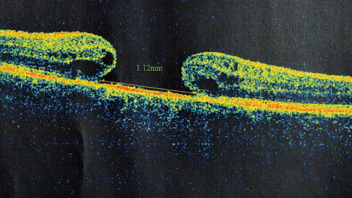 Know Your Vitreomacular Interface Disorders
