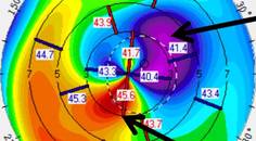 Collaborative Case 008 IOL Selection Challenge